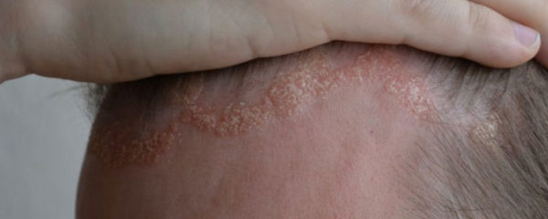 Eczema du cuir chevelu