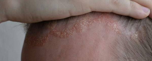 Eczema du cuir chevelu