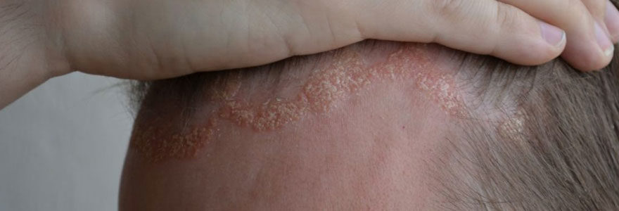 Eczema du cuir chevelu